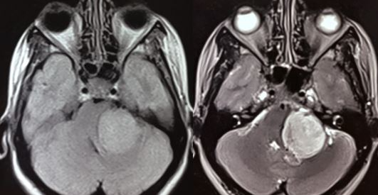 Acoustic neuroma