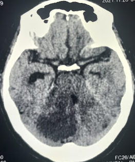 <p>Acute Cerebellar Infarction on CT Study</p>