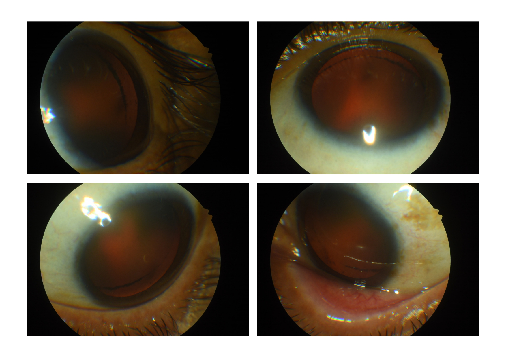 Zentmayer line (Schie line) in an eye with pigment dispersion syndrome