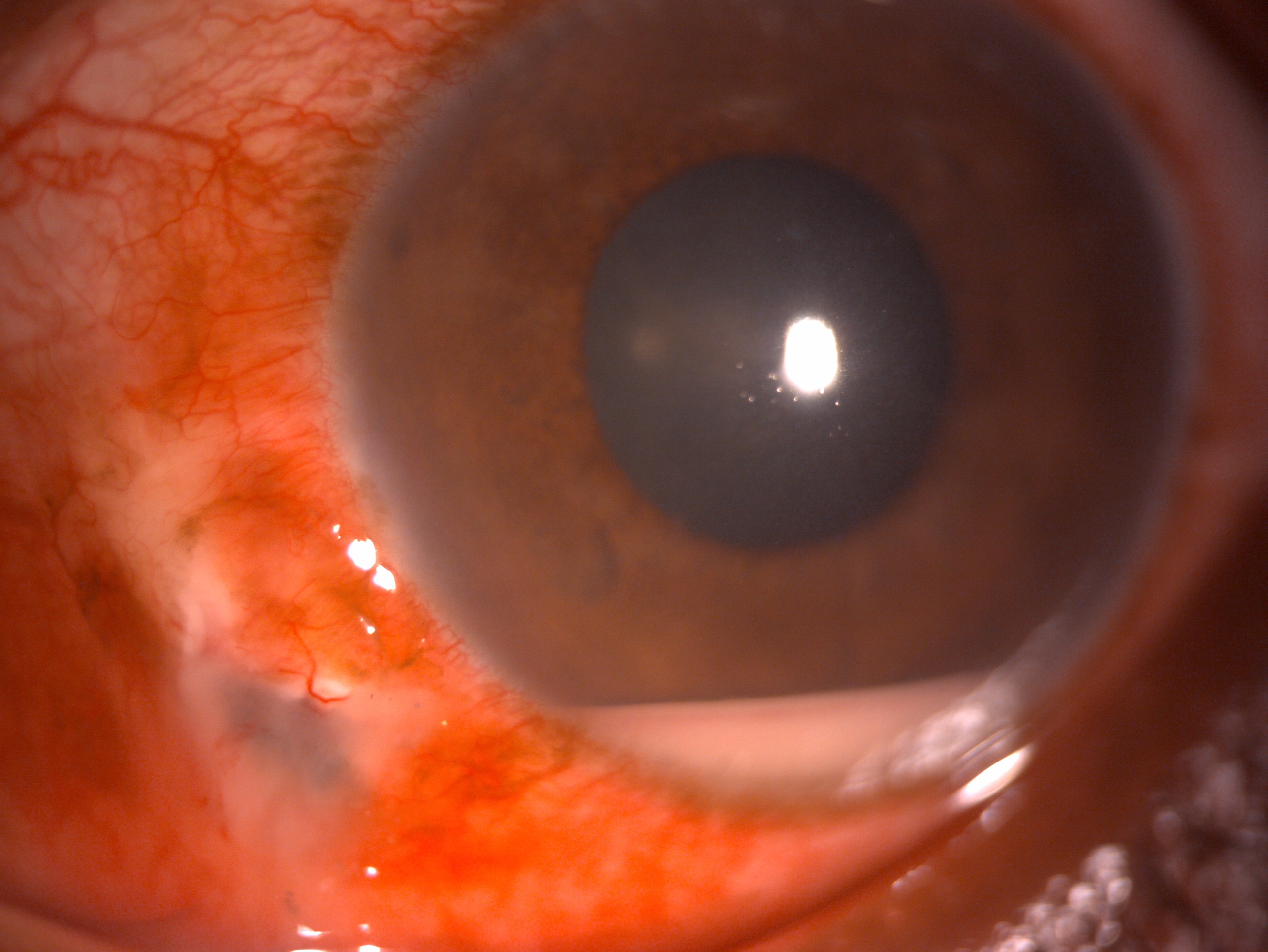 Digital slit lamp image of the patient depicting diffuse conjunctival congestion, inferotemporal scleral tear, 2 mm hypopyon 