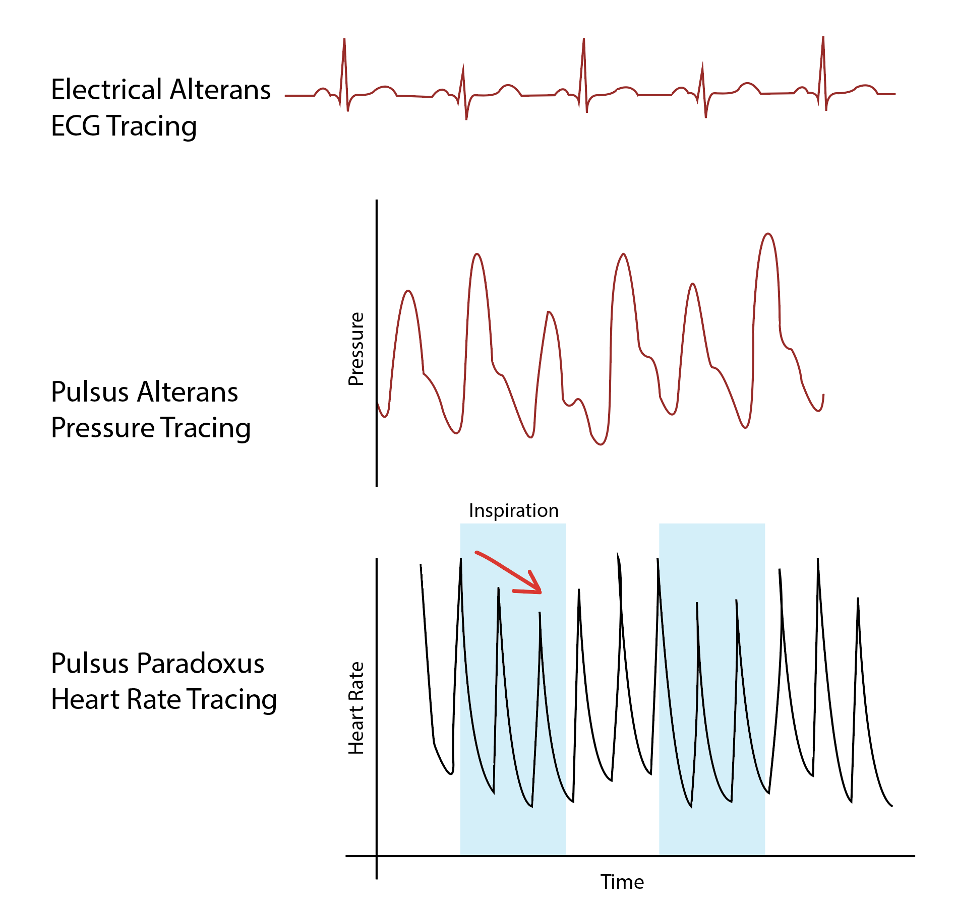 Diagram of electrical alterans, pulsus alterans, and pulsus paradoxus.