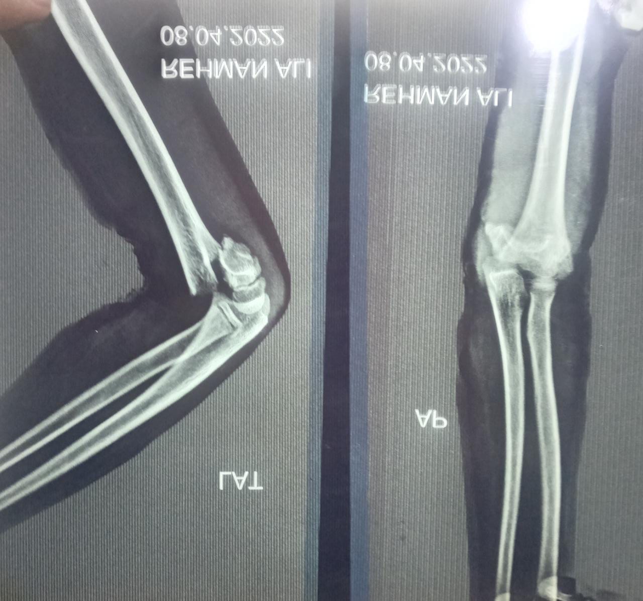 Supracondylar Humerus Fracture