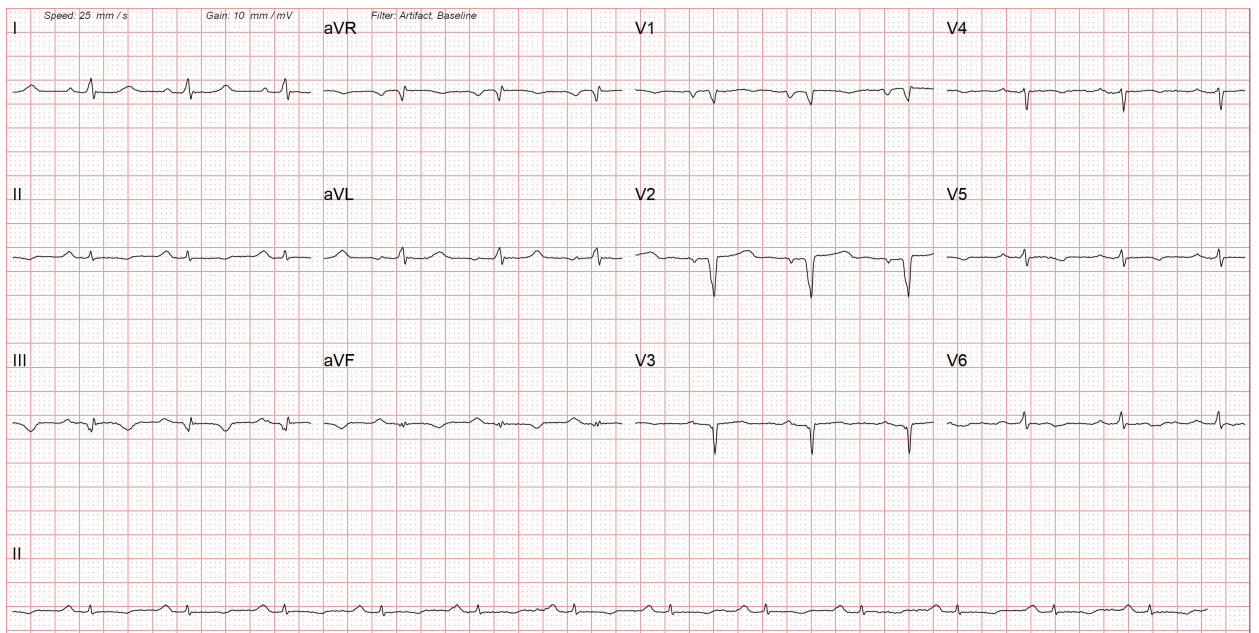 A 12-lead electrocardiogram of a patient with cardiac amyloidosis