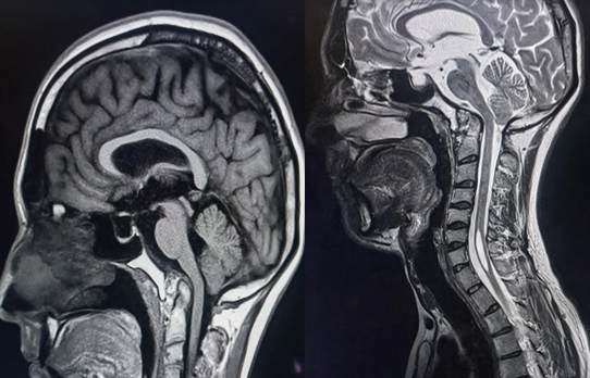 <p>Syrinx Visualized on MRI in a Patient With Basilar Invagination.</p>