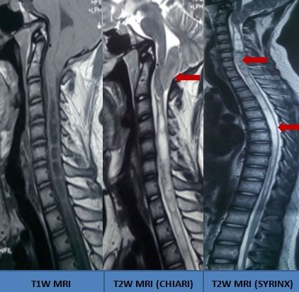 <p>Holocord Syrinx Visualized on MRI in a Patient With Chiari Malformation.</p>