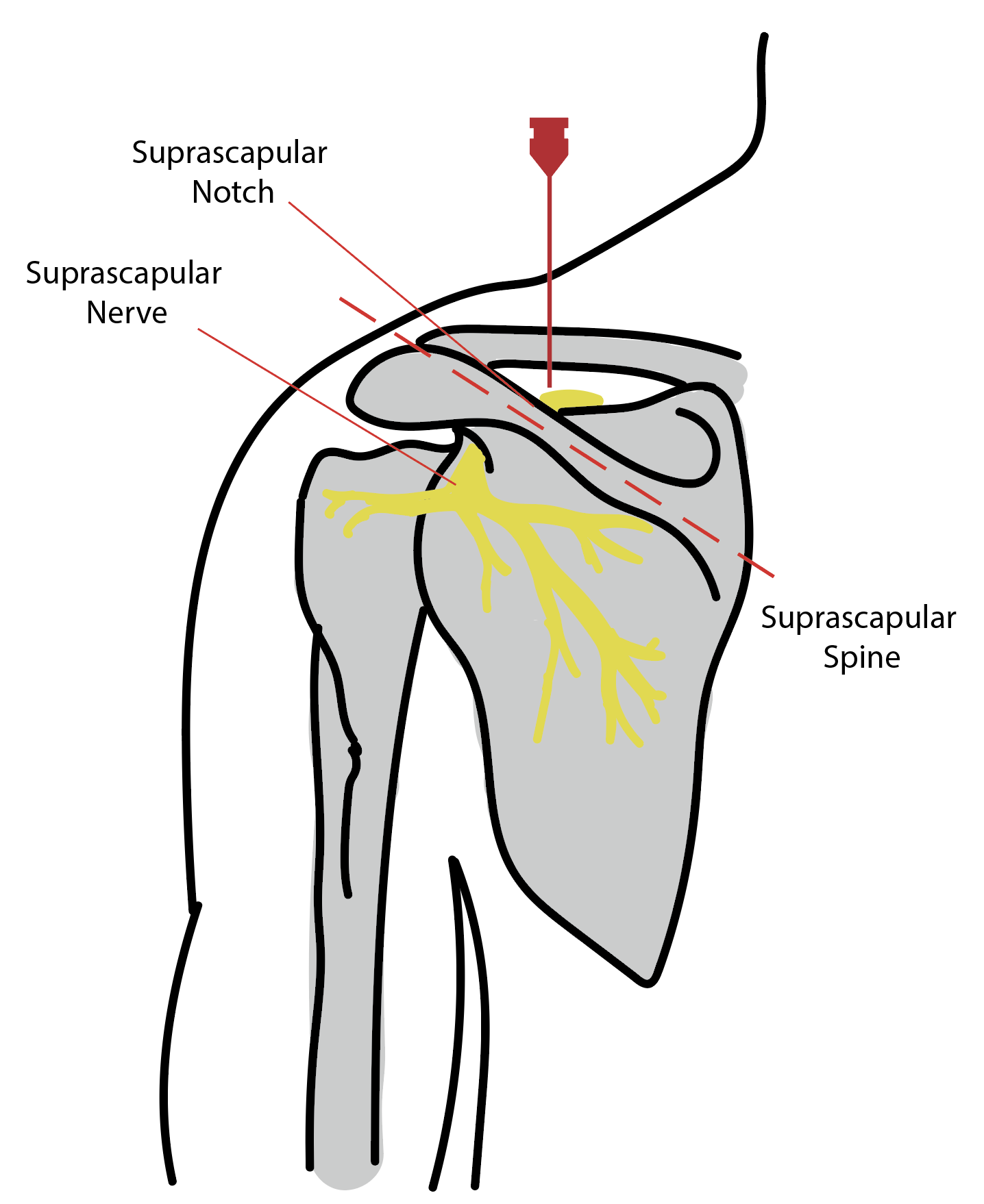 <p>Suprascapular Nerve Block</p>