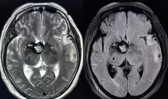 Third ventricular cavernoma