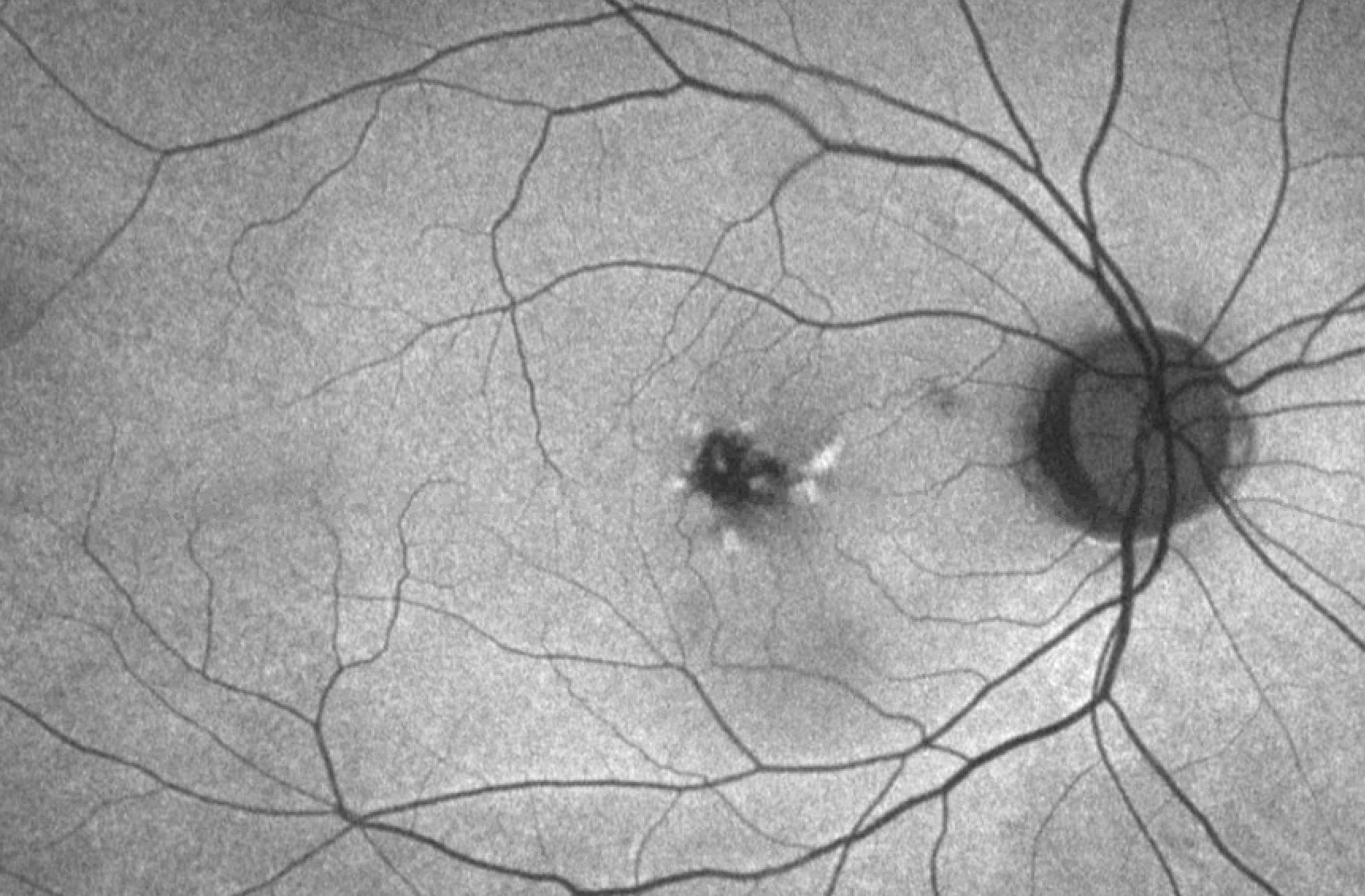 FAF with both increased and decreased autofluorescence corresponding to lipofuscin changes in butterfly pattern dystrophy.