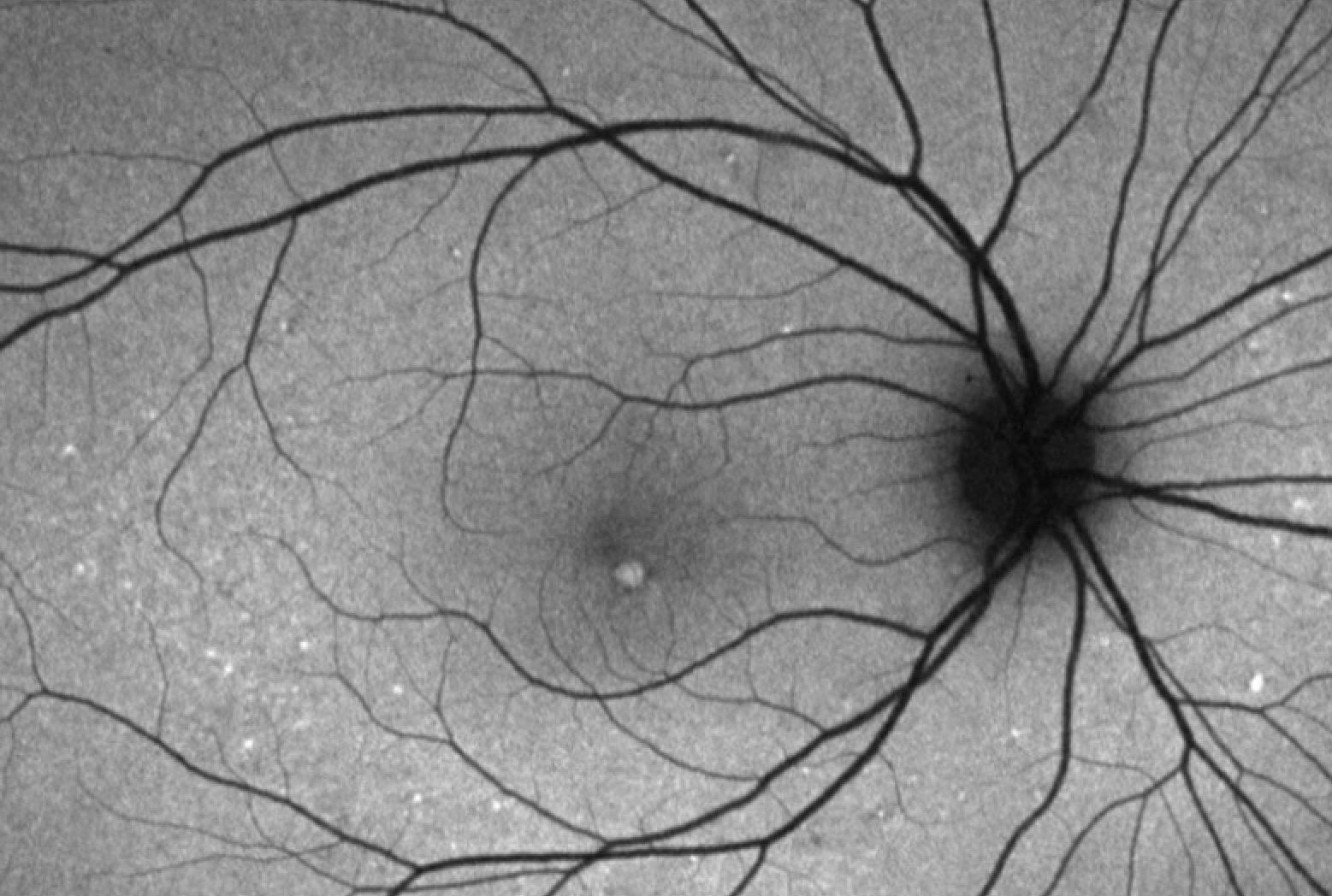 FAF of adult onset foveomacular vitelliform dystrophy.