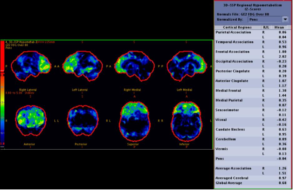 <p>Frontotemporal Dementia