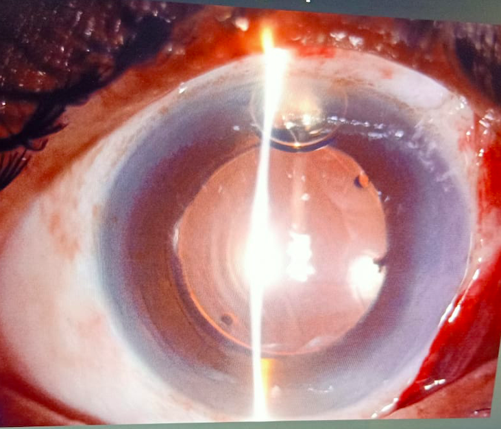 Digital image depicting postoperative SICS image of the patient depicting stable IOL.