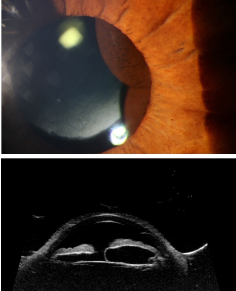 <p>Cystic Iris Lesion