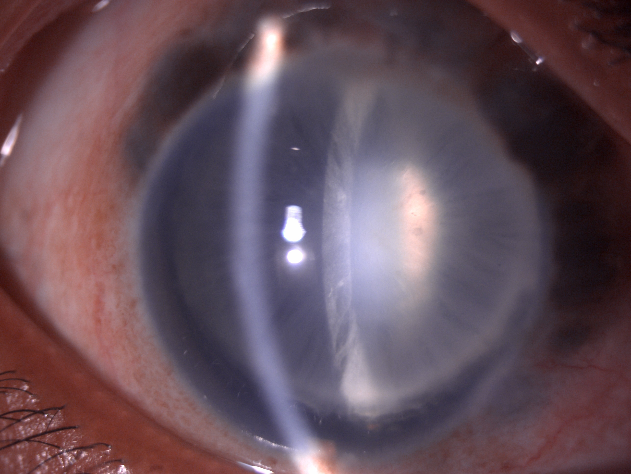 Digital image of the patient depicting mild congestion, scleral thinning, uveal show, deep anterior chamber, zonular dialysis