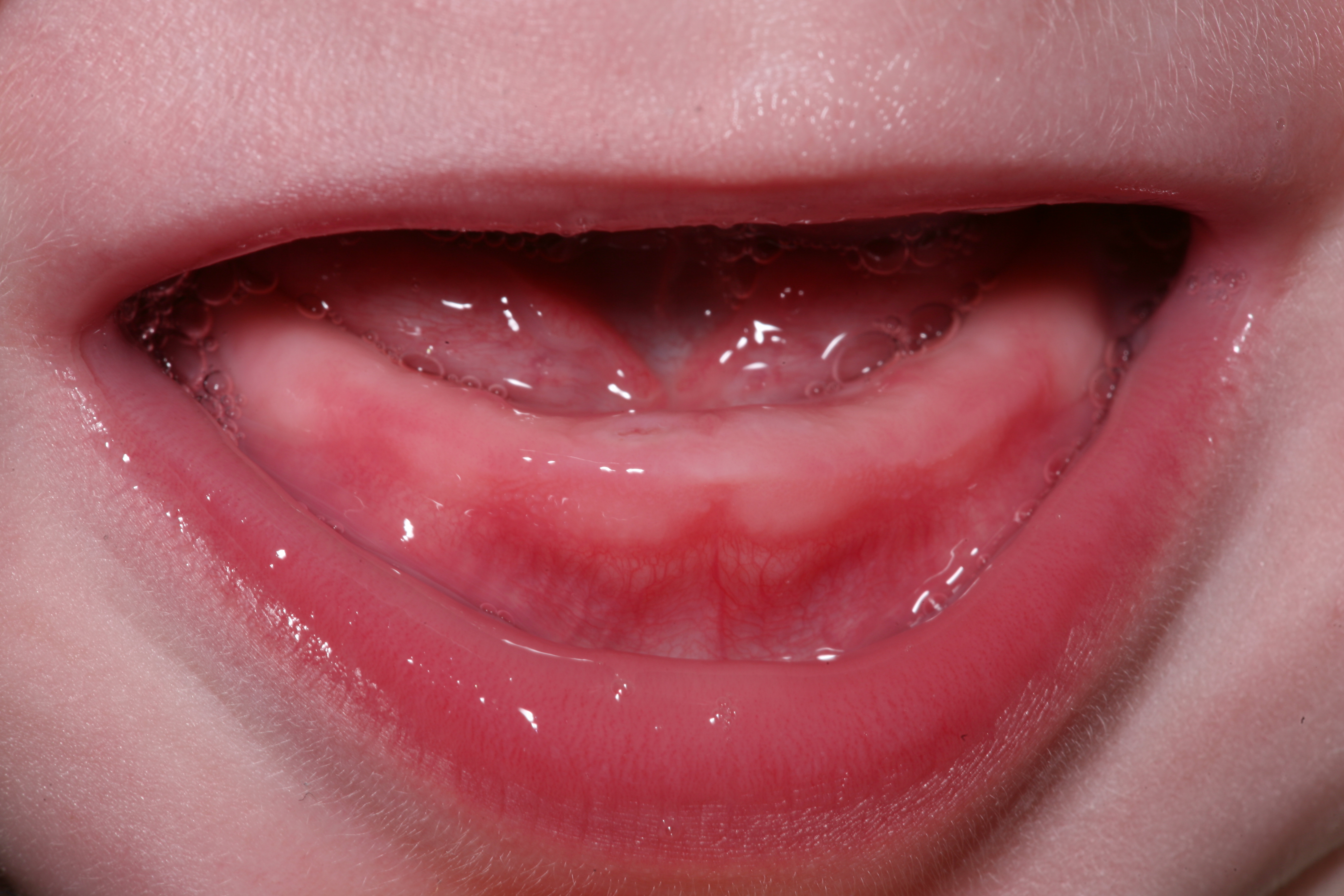 <p>First Sign of Right Incisor Breakthrough. Lower right incisor breaking through the oral mucosa of a teething baby.</p>
