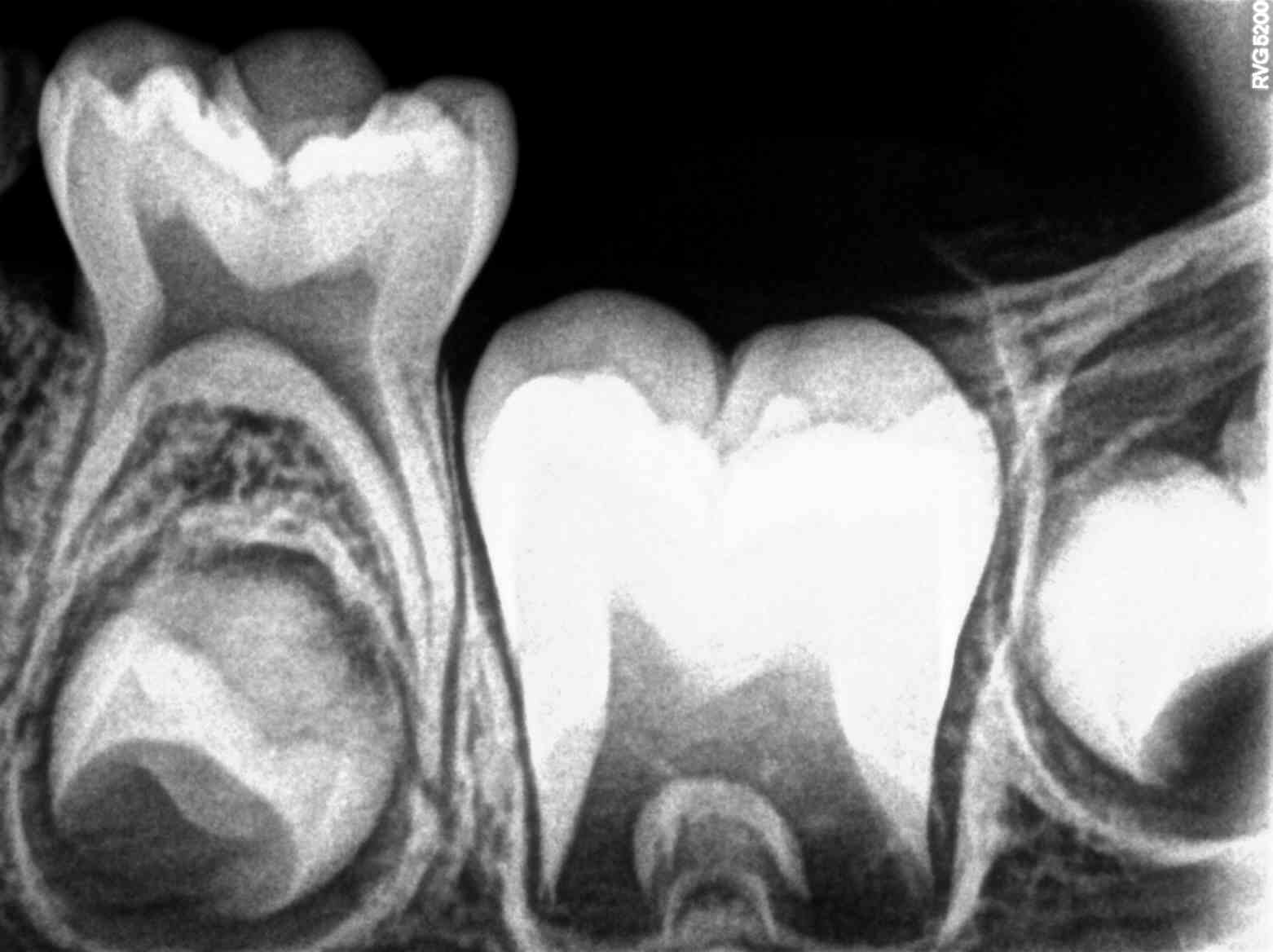 <p>Post-Occlusal Eruption