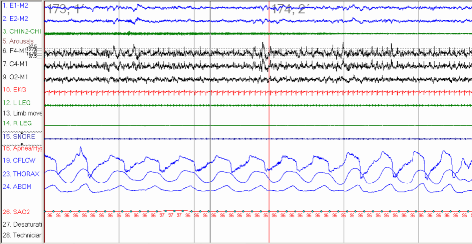 <p>Sleep Polygraph, 30-Second Window