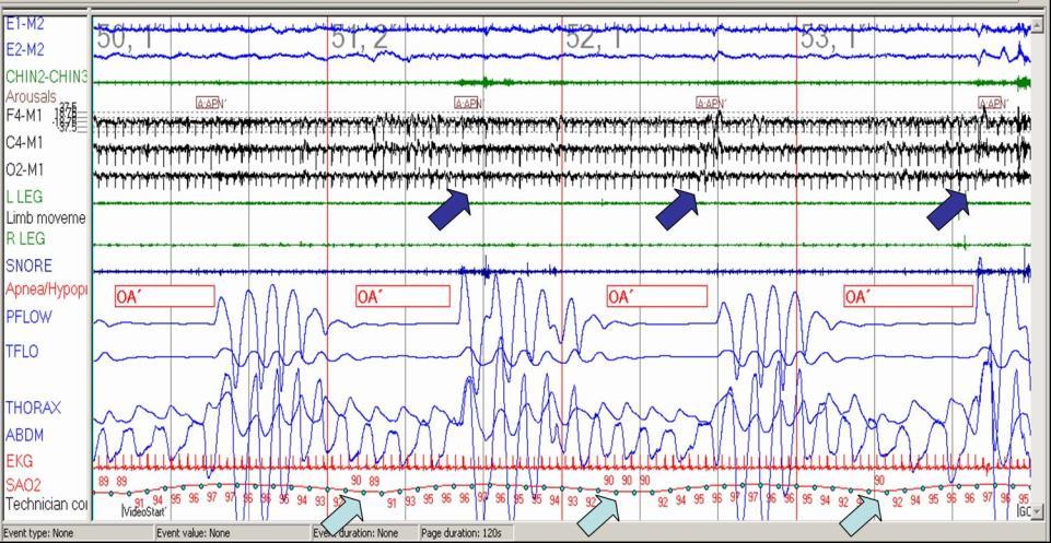 <p>Sleep Polygraph, 120-Second Window