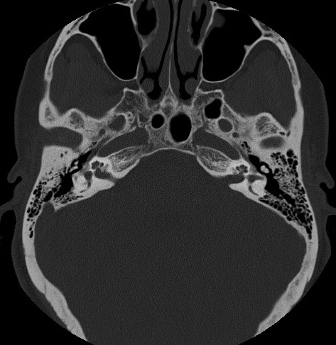 Otosclerosis