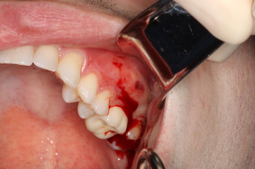 Acute Apical Abscess