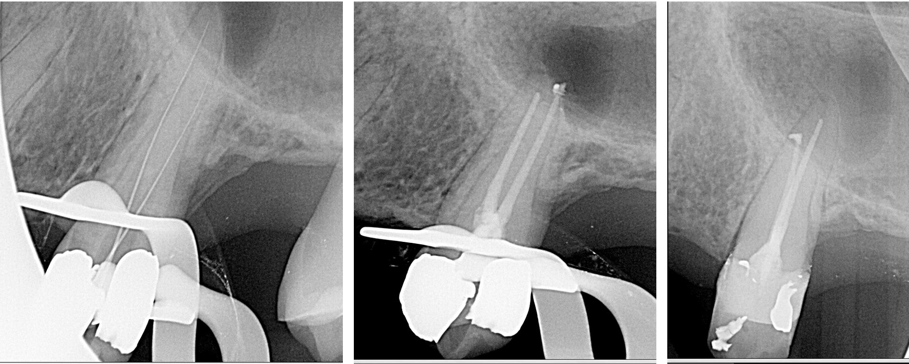 Non-surgical root canal therapy.