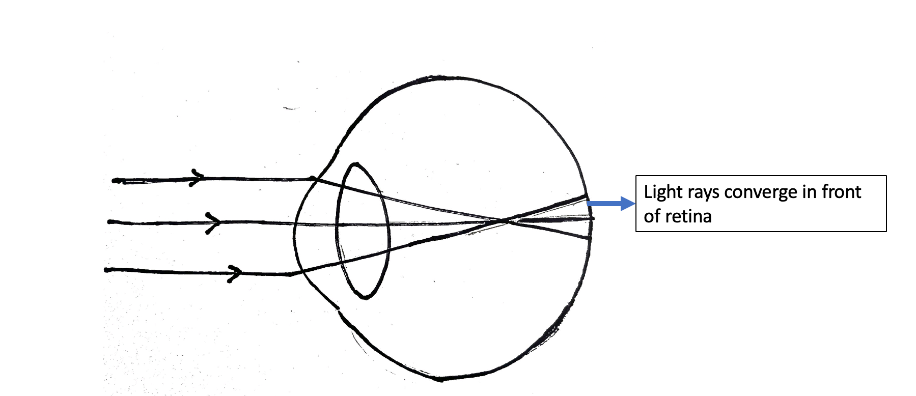 Ray diagram showing parallel rays being focused in front of retina