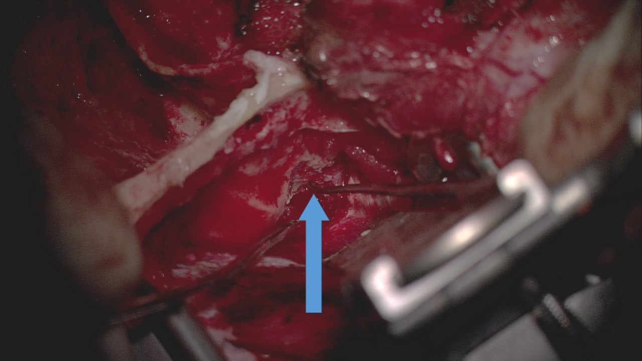 Middle fossa craniotomy approach to facial nerve decompression