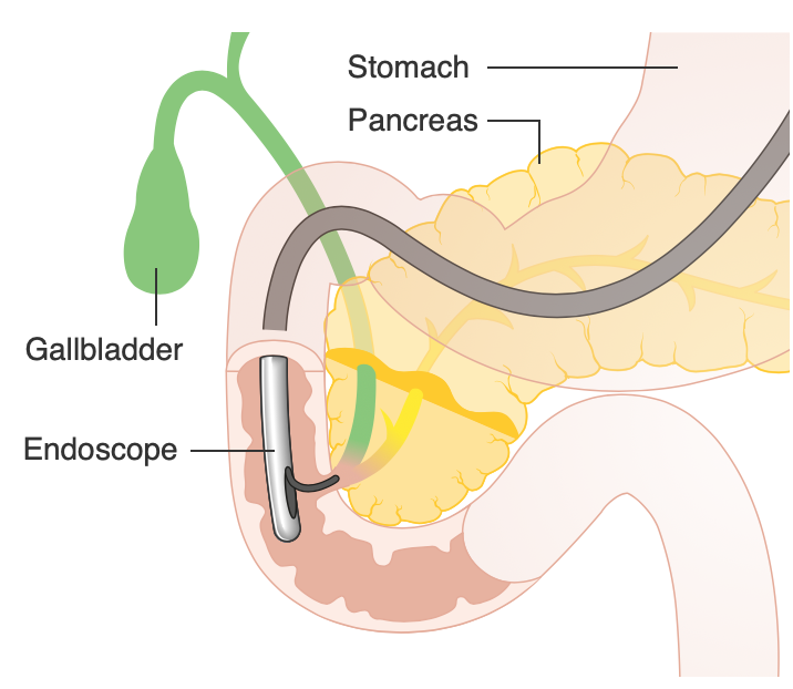 Diagrammatic representation of endoscopic retrograde cholangiopancreatography