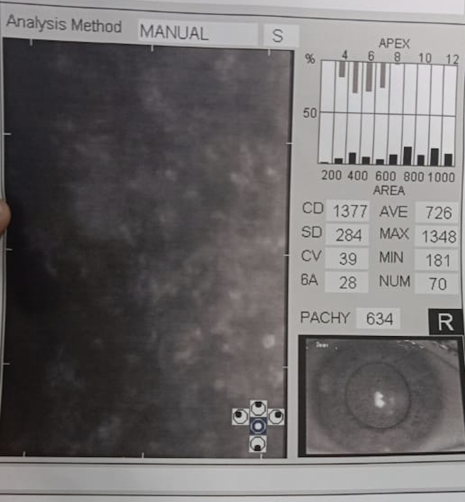 <p>Fuchs Endothelial Corneal Dystrophy