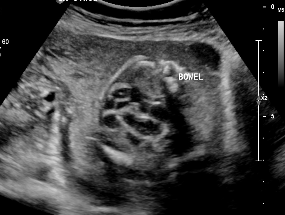 <p>Fetal Echogenic Bowel, Ultrasound