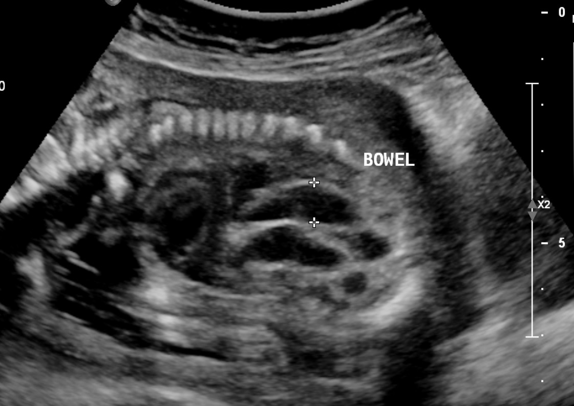 Fetal bowel echogenicity