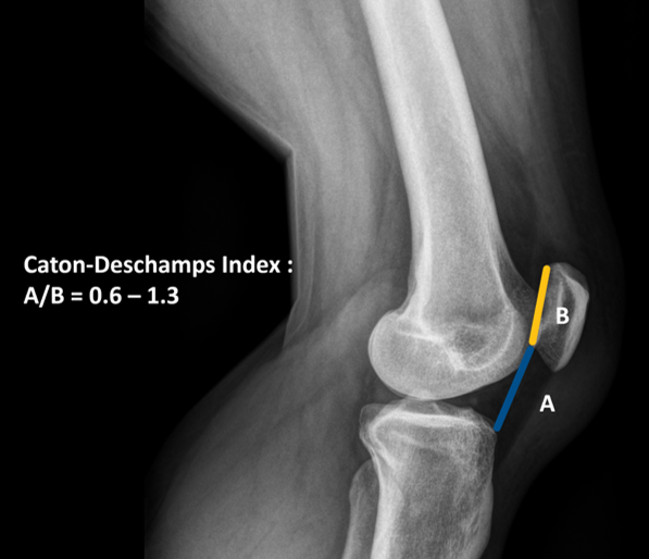 Caton-Deschamps Index