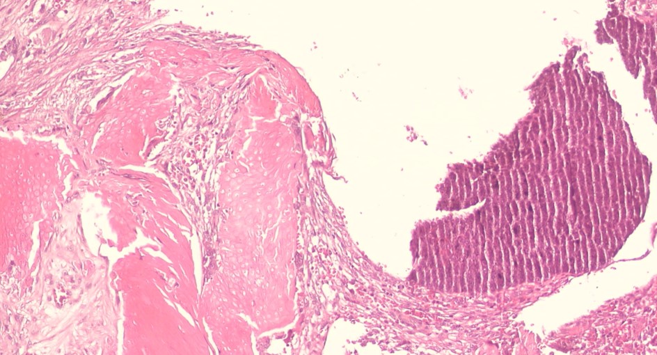 <p>Pilomatrixoma Histopathology, Low Magnification