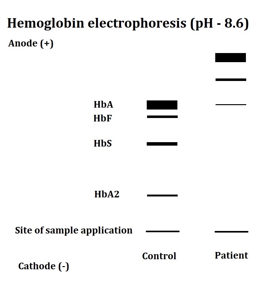 Alpha thalassemia major - showing presence of HbH and Hb Bart's with scanty HbA.