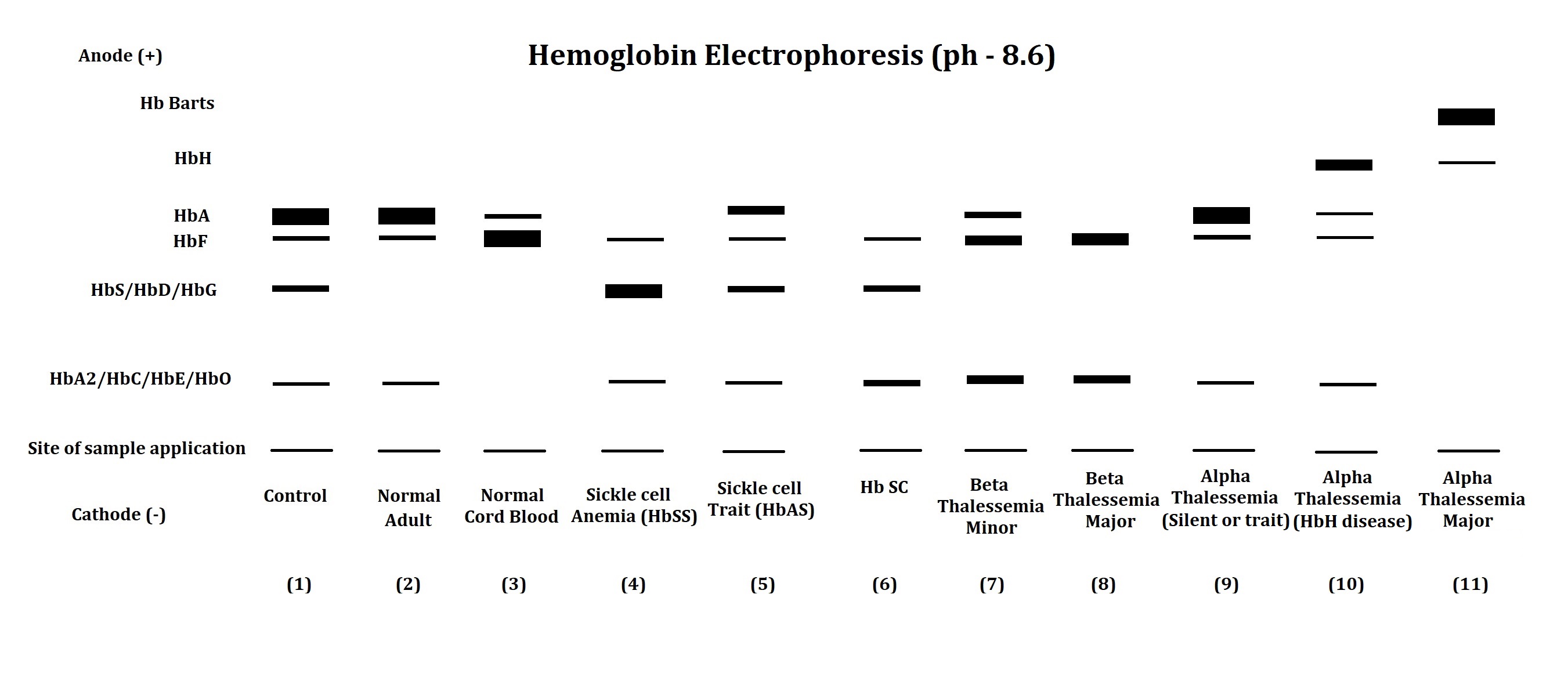 Hemoglobin electrophoresis pattern in different hemoglobinopathies and thalassemia.