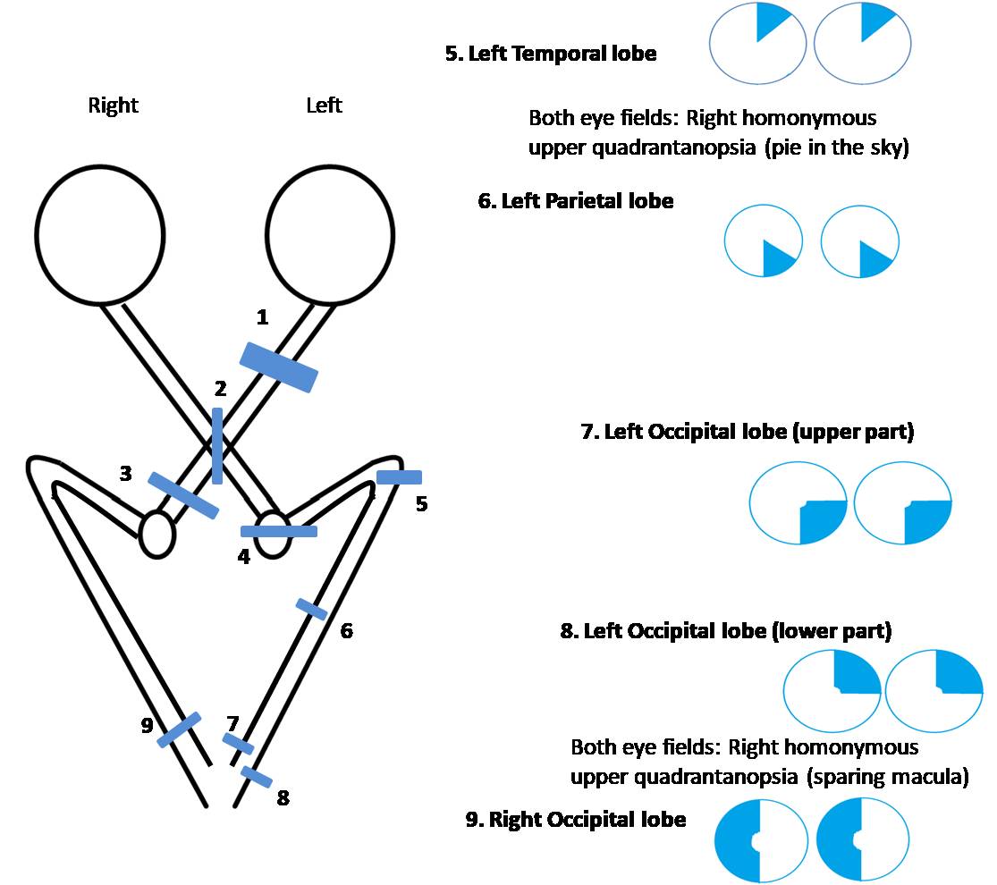 Field defects due to disorder in the visual pathway