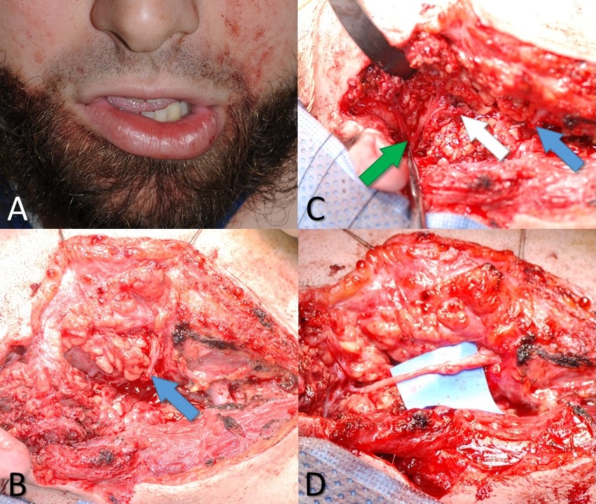 <p>Marginal Mandibular Branch of the Facial Nerve&nbsp;Injury