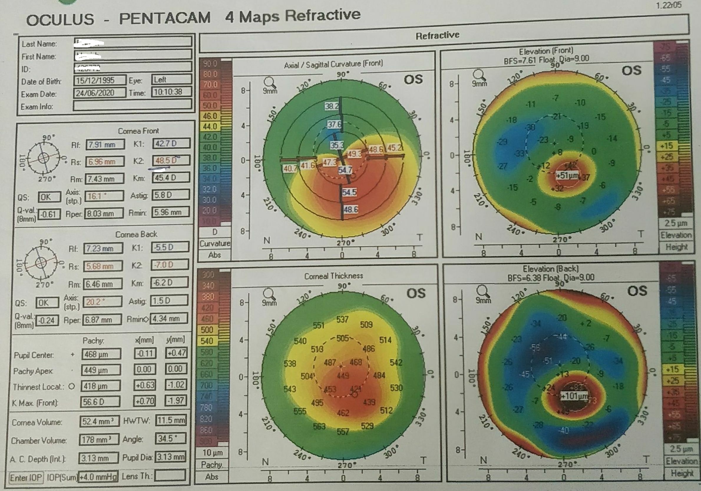 Pentacam image of a 25 year old male diagnosed to have keratoconus.