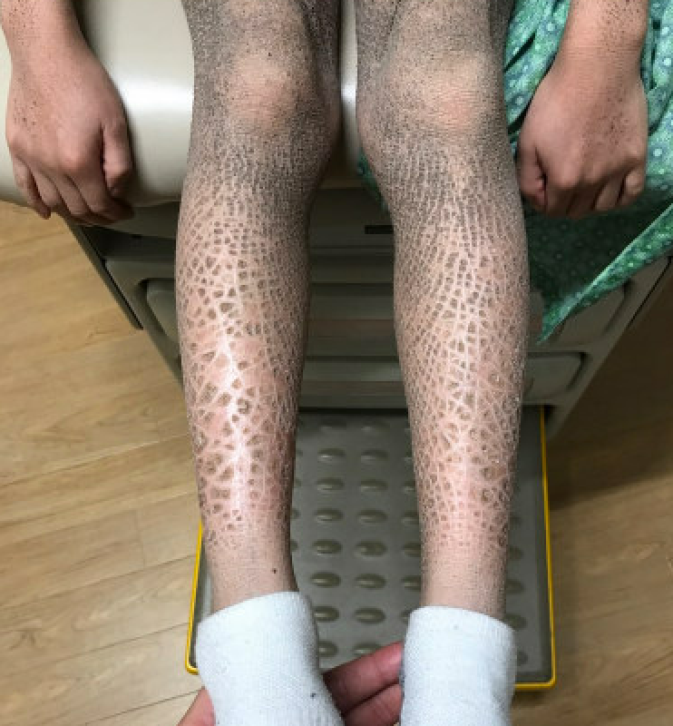 X-linked ichthyosis