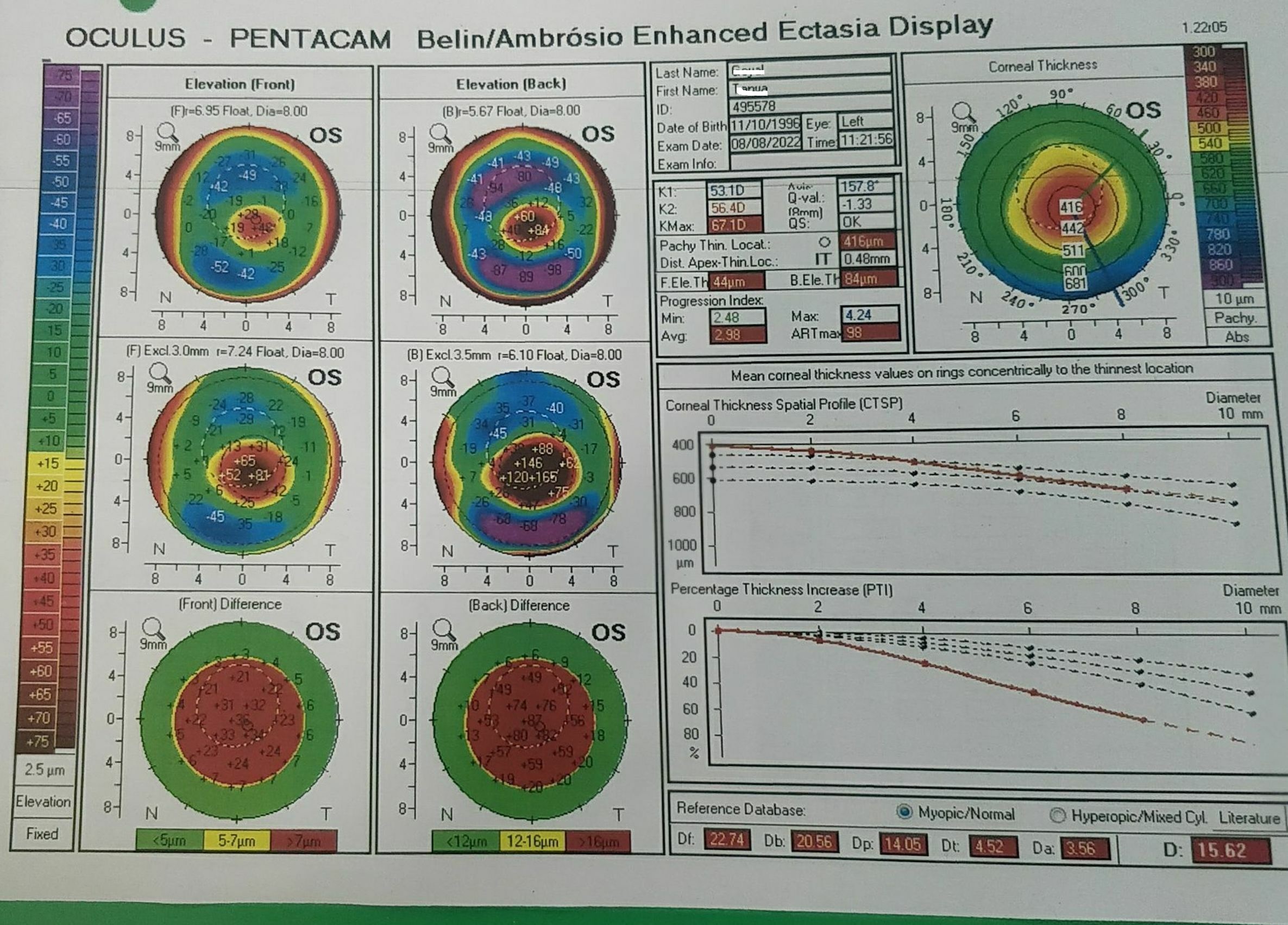 Belin- Ambrosio enhanced ectasia display of a 26 year old  female with keratoconus