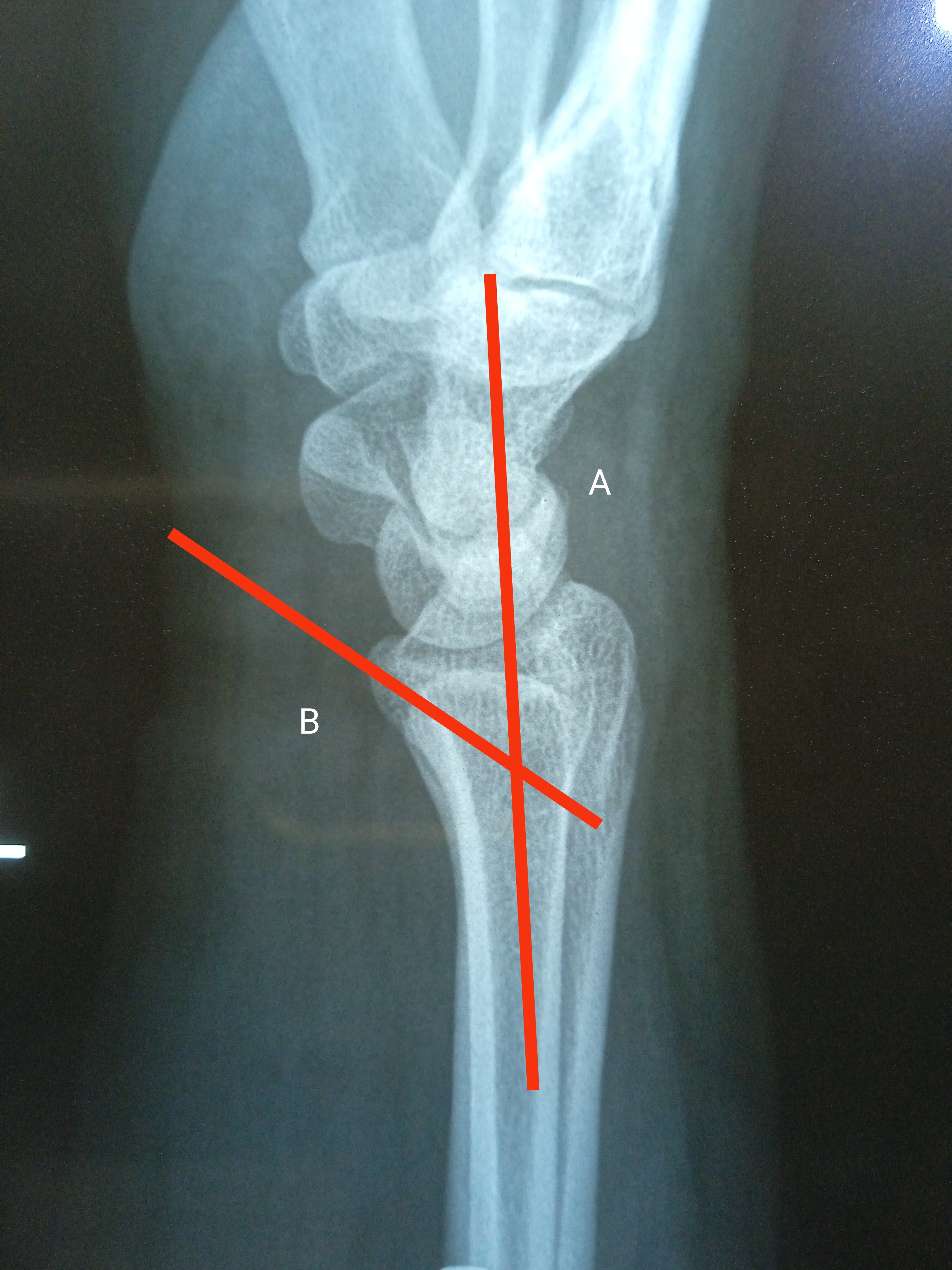 Tear-drop Angle: A line is drawn along the shaft of radius and line B passes through lunate facet/tear drop