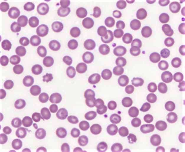 Target cell in Peripheral smear