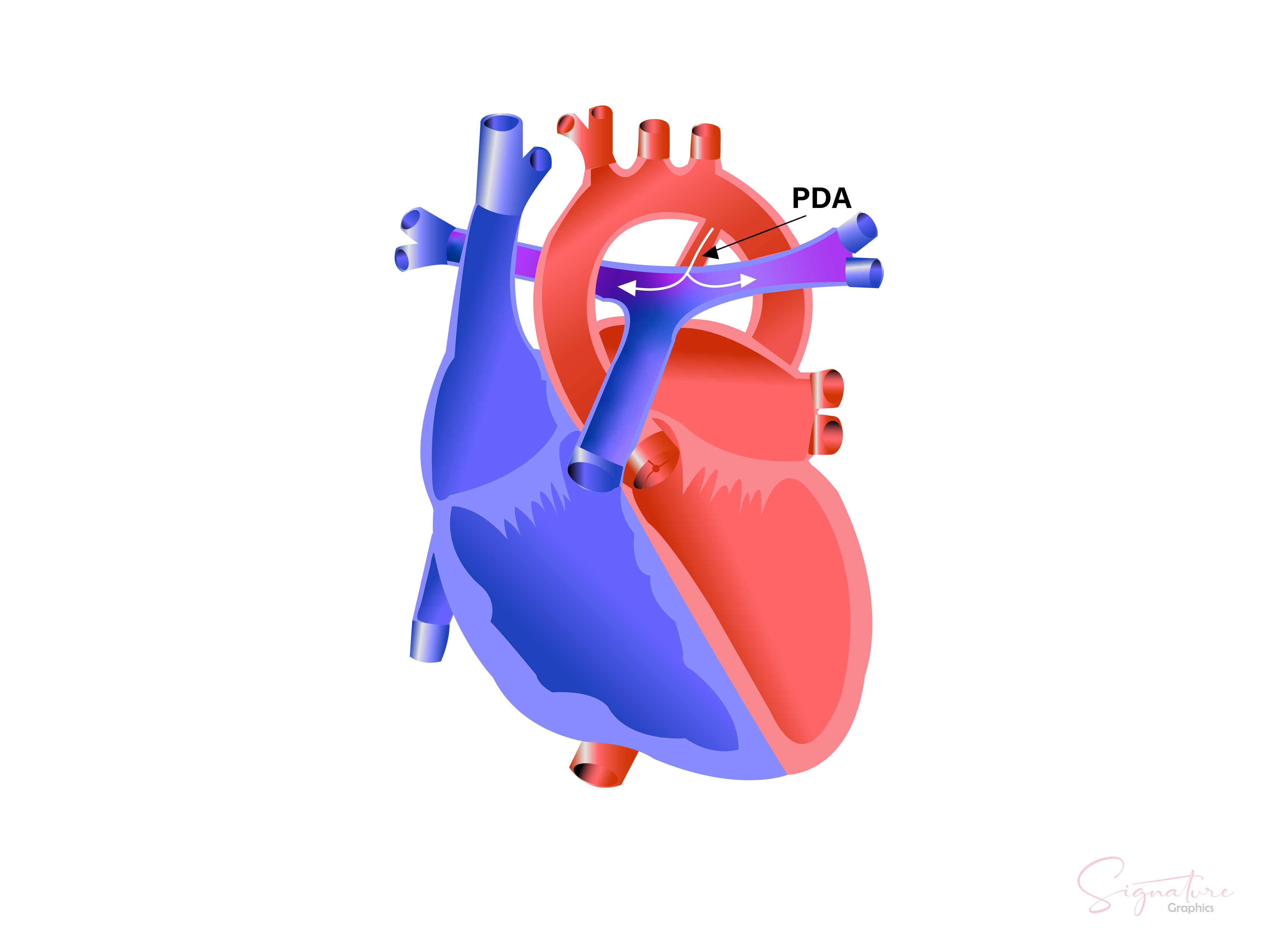 This images illustrates the location of patent ductus arteriosus.