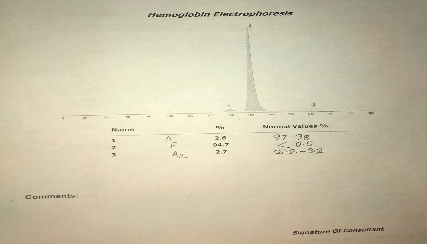 Hemoglobin electrophoresis showing Beta thalassemia Major