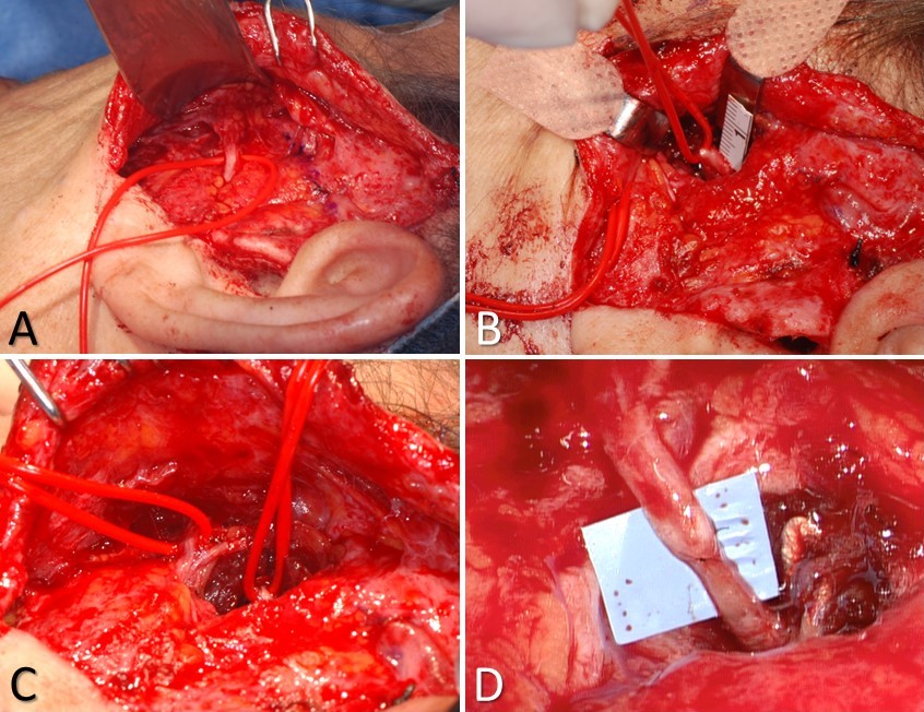 Masseteric nerve transfer: A) the buccal branch controlling the zygomaticus major muscle is identified at Zuker's point (halfway between the helical root and the oral commissure), B) the masseteric nerve is identified 3 cm anterior to the tragus, 1 cm inferior to the zygomatic arch, and 1