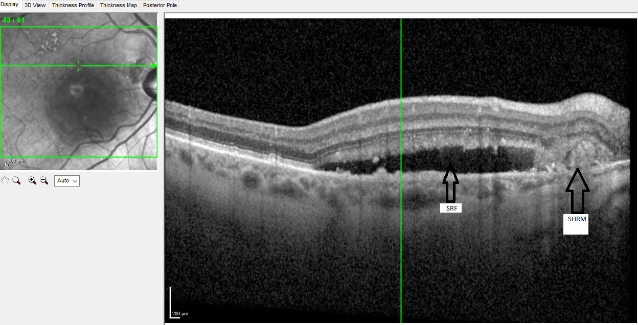 <p>Peripapillary Choroidal Neovascular Membrane