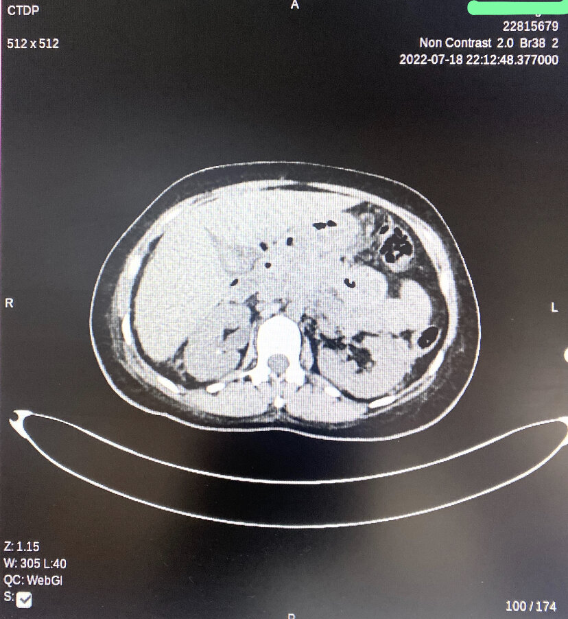 <p>Peripancreatic Necrotic Fluid Shown on CT