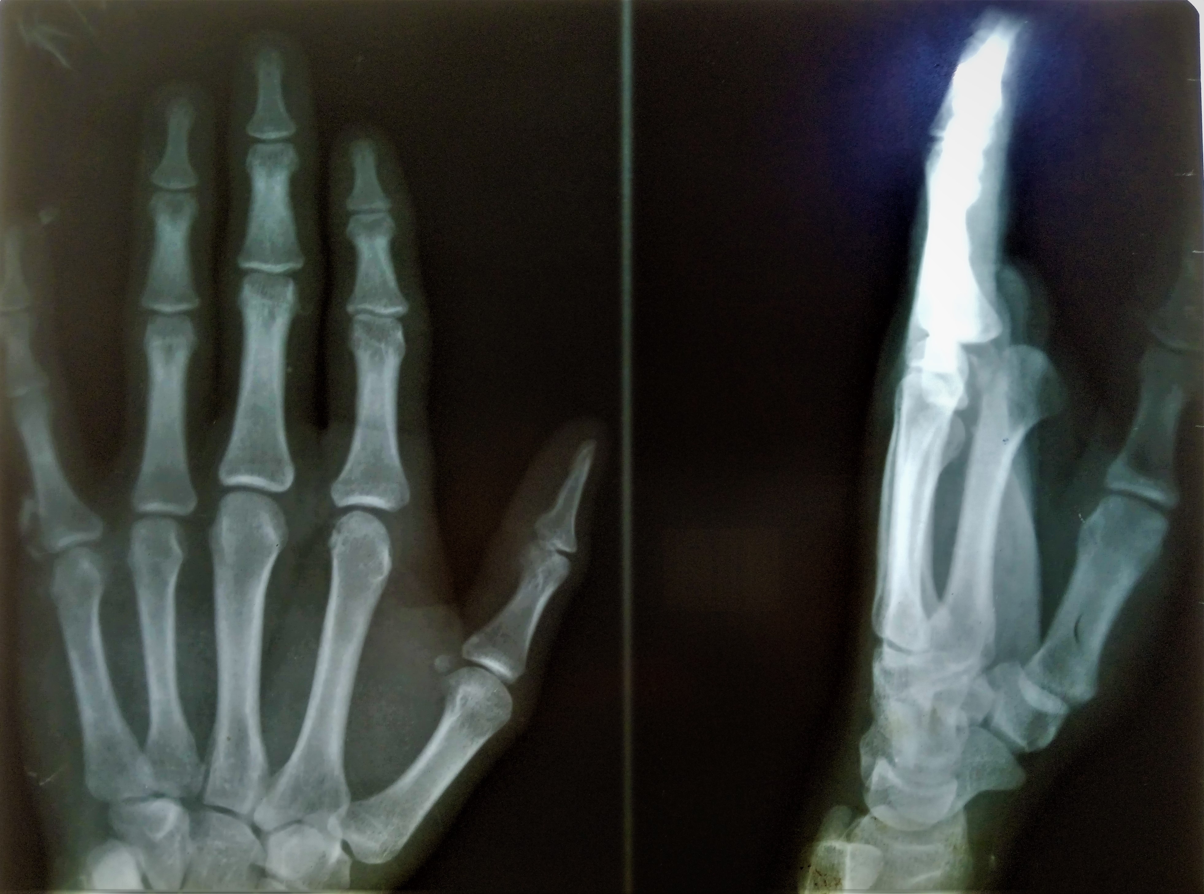 <p>Metacarpophalangeal Joint Dorsal Dislocation. MCP joint dorsal dislocation of&nbsp;the index finger.</p>