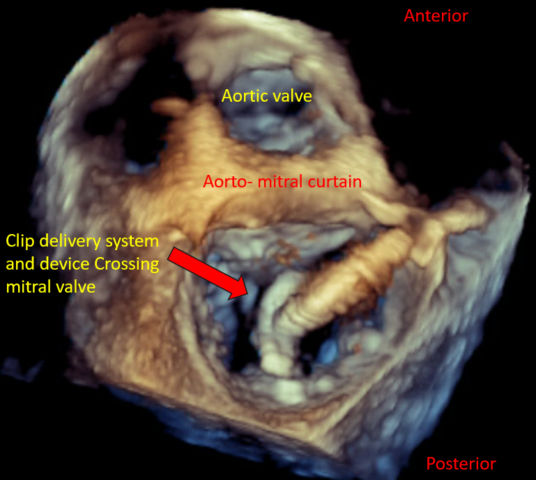 <p>Device Orientation in Percutaneous Mitral Valve Repair