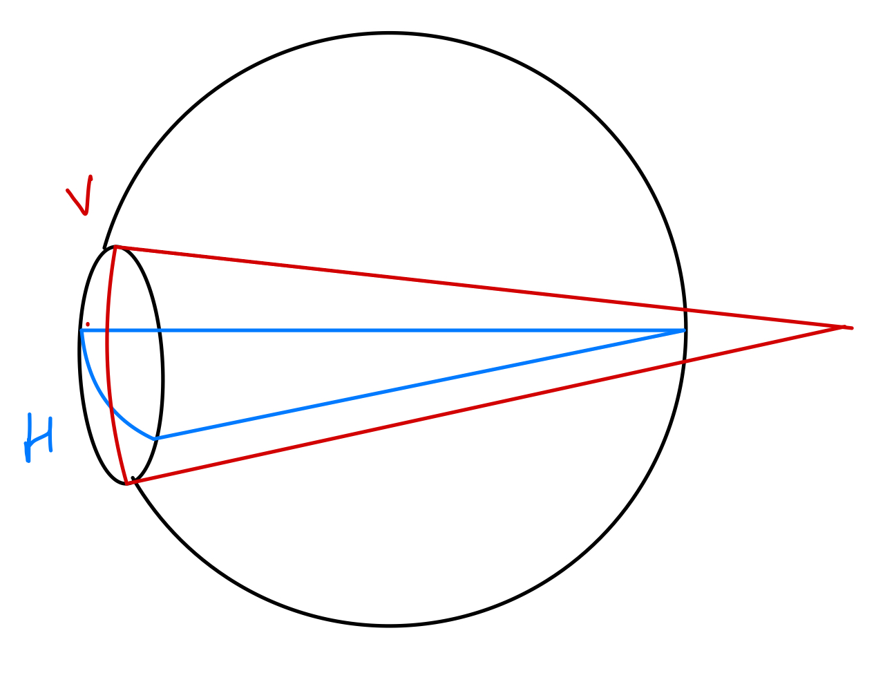 Simple hypermetropic astigmatism