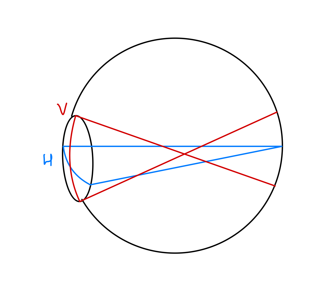 Simple myopic astigmatism